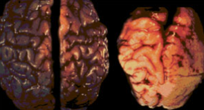Brain diagram showing regions affected by prenatal alcohol exposure